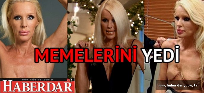 Göğüslerine et yiyen bakteri yerleşti