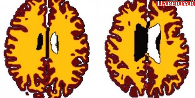 Aşırı kilo beyni yaşlandırıyor