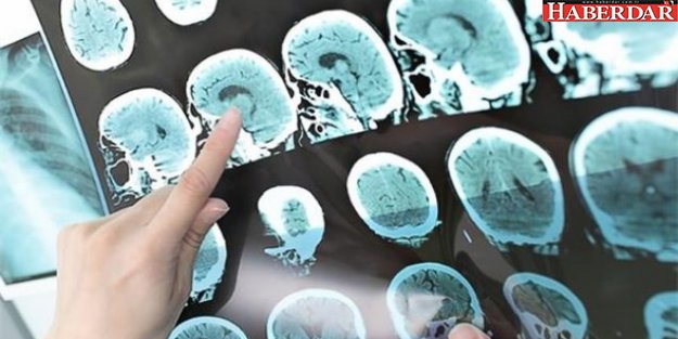 Alzheimer hastalarına iyi haber