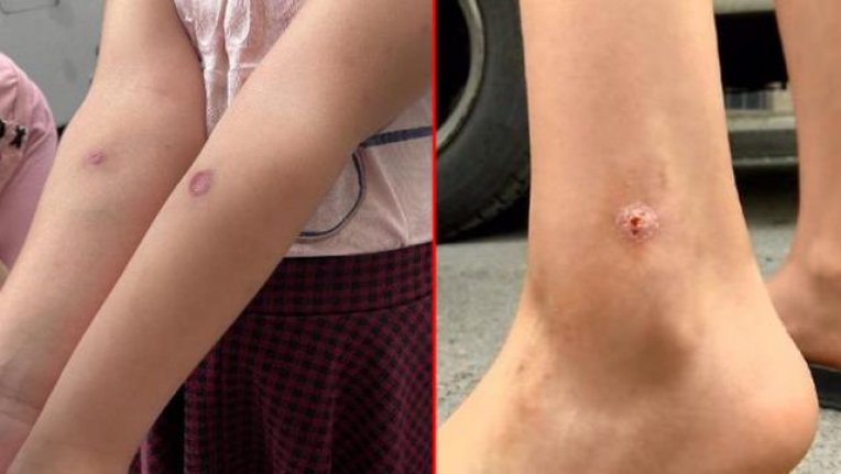 Korona bitmeden İstanbul'un göbeğinde yeni kabus! Sivrisineklerin soktuğu çocuklarda yaralar oluşmaya başladı