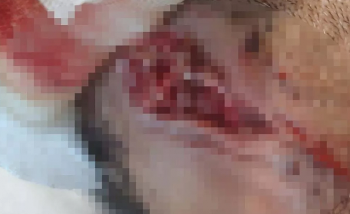 Küçükçekmece'deki pitbullu saldırı: Kulağını kaybetme ihtimali yüzde 90