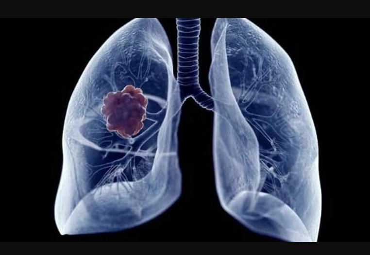 Sigara içen ve pasif içici olanları ilgilendiriyor: İşte Akciğer kanserinden korunmanın 7 yolu